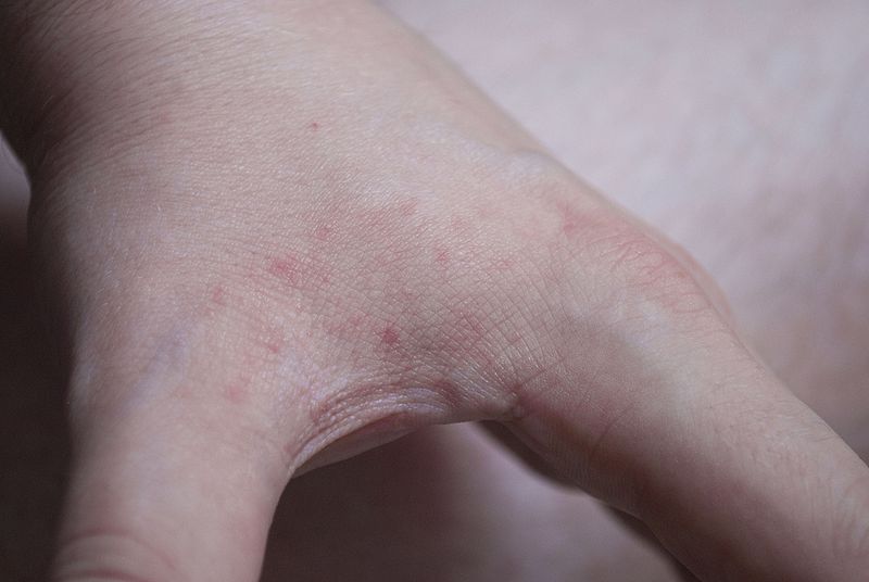 bedbug bites picture